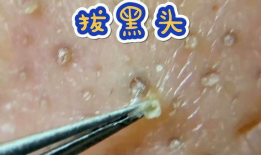 粉刺视频